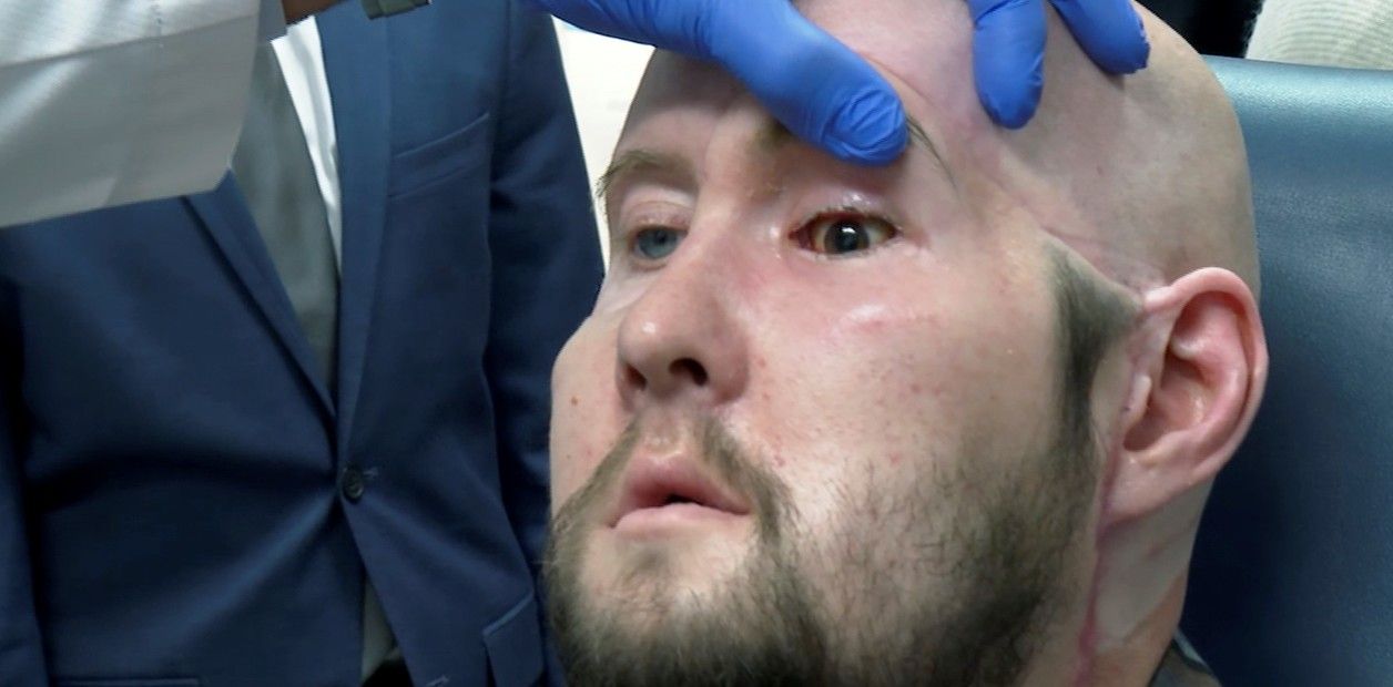 Por primera vez se realizó un trasplante de ojo completo