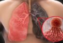 El cáncer de pulmón vuelve a ser el más común en el mundo